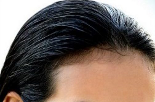 Receding Hairline in Women Causes, Treatment, Young Black Women