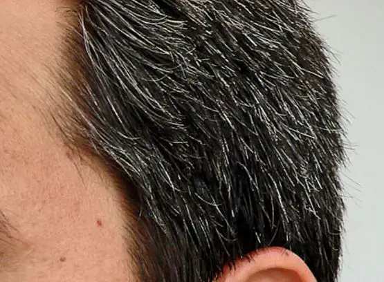 How To Get Rid Of White Hair Naturally Permanently On Beard Face 